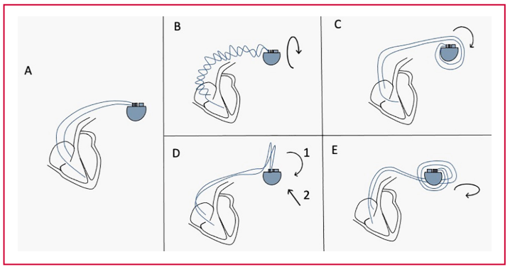 Pacemaker Widdler Síndrome de “flip”, un nuevo mecanismo de macrodesalojo de electrodos ...